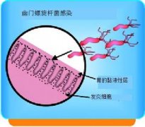 選擇傳統還是新銳，胃潰瘍