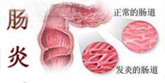 引起結腸炎的病因有哪些