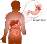 胃痛該如何判斷?