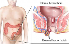 腸炎的危害有哪些