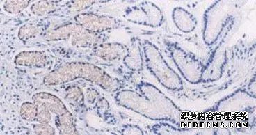 當心淺表性胃炎會引起這些嚴重的危害-當心淺表性胃炎會引起這些嚴重的危害