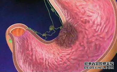 當心淺表性胃炎會引起這些嚴重的危害-當心淺表性胃炎會引起這些嚴重的危害