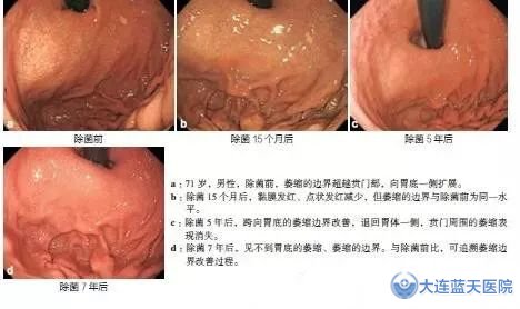 萎縮性胃炎究竟是怎么回事？