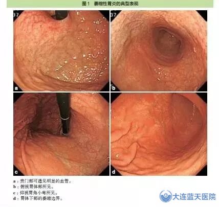 萎縮性胃炎究竟是怎么回事？